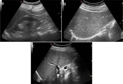 A New SteatoScore in the Evaluation of Non-Alcoholic Liver Disease in Oncologic Patients